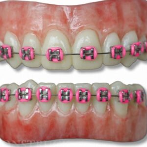 Anwen Teeth Braces Pink